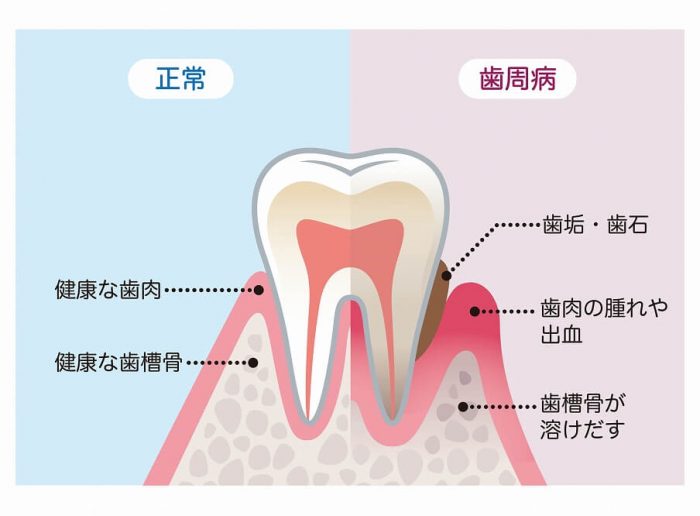 そもそも歯周病とは？