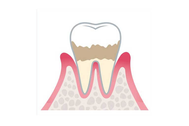 軽度歯周炎