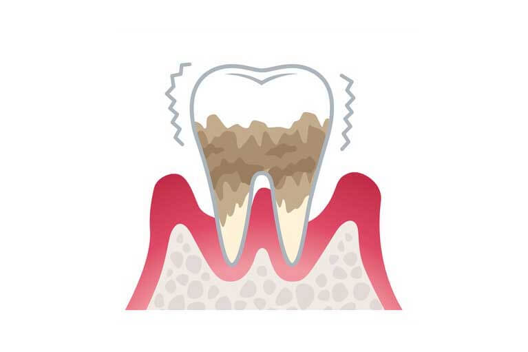 重度歯周炎