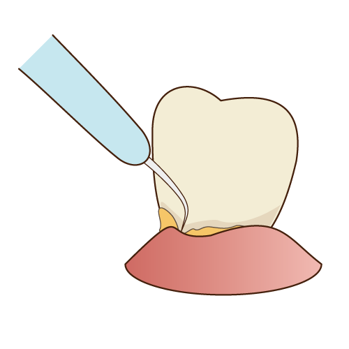 歯石除去の方法