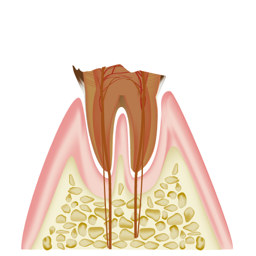 C4歯の根以外がほとんど溶ける